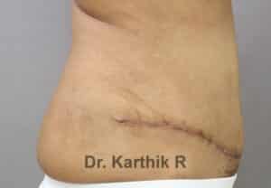 Tummy Tuck