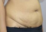 Tummy Tuck