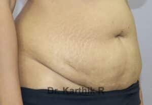 Tummy Tuck