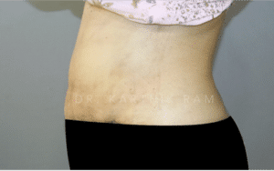 Tummy Tuck