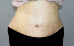 Tummy Tuck