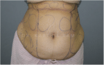 Tummy Tuck