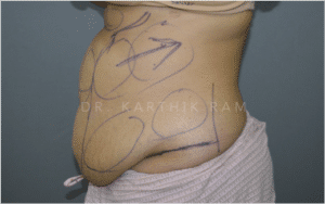 Tummy Tuck