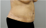 Tummy Tuck