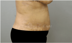Tummy Tuck