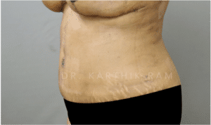 Tummy Tuck