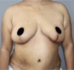 Breast Reduction and Breast Lift