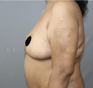 Breast Reduction and Breast Lift