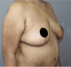 Breast Reduction and Breast Lift