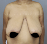 Breast Reduction and Breast Lift