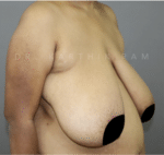 Breast Reduction and Breast Lift