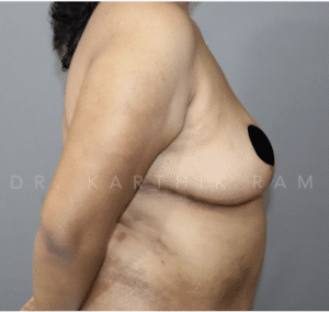 Breast Reduction and Breast Lift