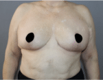 Breast Reduction and Breast Lift