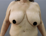 Breast Reduction and Breast Lift