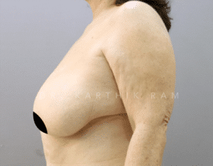 Breast Reduction and Breast Lift