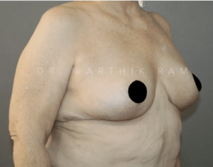 Breast Reduction and Breast Lift