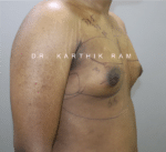 Gynecomastia (Puffy Nipples/ Male Chest Correction)