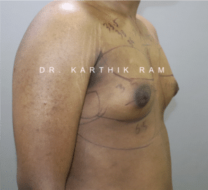 Gynecomastia (Puffy Nipples/ Male Chest Correction)