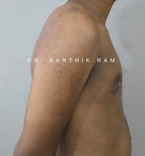 Gynecomastia (Puffy Nipples/ Male Chest Correction)