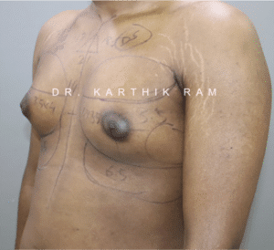 Gynecomastia (Puffy Nipples/ Male Chest Correction)