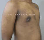 Gynecomastia (Puffy Nipples/ Male Chest Correction)