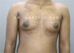 Gynecomastia (Puffy Nipples/ Male Chest Correction)