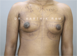 Gynecomastia (Puffy Nipples/ Male Chest Correction)