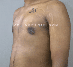 Gynecomastia (Puffy Nipples/ Male Chest Correction)