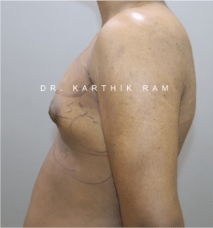 Gynecomastia (Puffy Nipples/ Male Chest Correction)