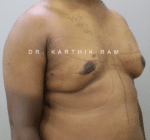 Gynecomastia (Puffy Nipples/ Male Chest Correction)