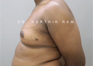 Gynecomastia (Puffy Nipples/ Male Chest Correction)