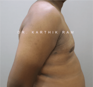 Gynecomastia (Puffy Nipples/ Male Chest Correction)
