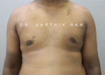 Gynecomastia (Puffy Nipples/ Male Chest Correction)