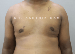 Gynecomastia (Puffy Nipples/ Male Chest Correction)