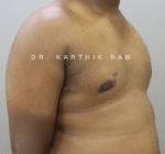 Gynecomastia (Puffy Nipples/ Male Chest Correction)