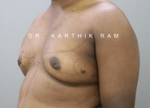Gynecomastia (Puffy Nipples/ Male Chest Correction)