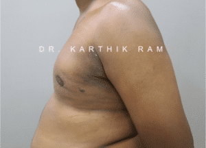 Gynecomastia (Puffy Nipples/ Male Chest Correction)