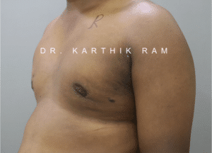 Gynecomastia (Puffy Nipples/ Male Chest Correction)