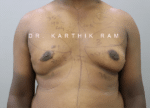 Gynecomastia (Puffy Nipples/ Male Chest Correction)