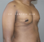 Gynecomastia (Puffy Nipples/ Male Chest Correction)