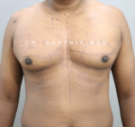 Gynecomastia (Puffy Nipples/ Male Chest Correction)