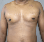 Gynecomastia (Puffy Nipples/ Male Chest Correction)