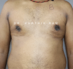 Gynecomastia (Puffy Nipples/ Male Chest Correction)