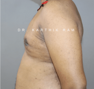 Gynecomastia (Puffy Nipples/ Male Chest Correction)
