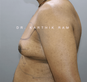 Gynecomastia (Puffy Nipples/ Male Chest Correction)