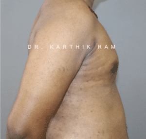 Gynecomastia (Puffy Nipples/ Male Chest Correction)
