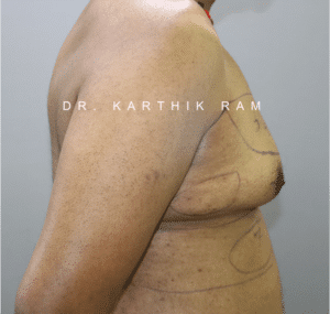 Gynecomastia (Puffy Nipples/ Male Chest Correction)