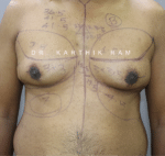 Gynecomastia (Puffy Nipples/ Male Chest Correction)