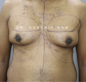 Gynecomastia (Puffy Nipples/ Male Chest Correction)