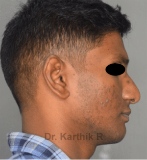 Rhinoplasty (Nose Corrections)